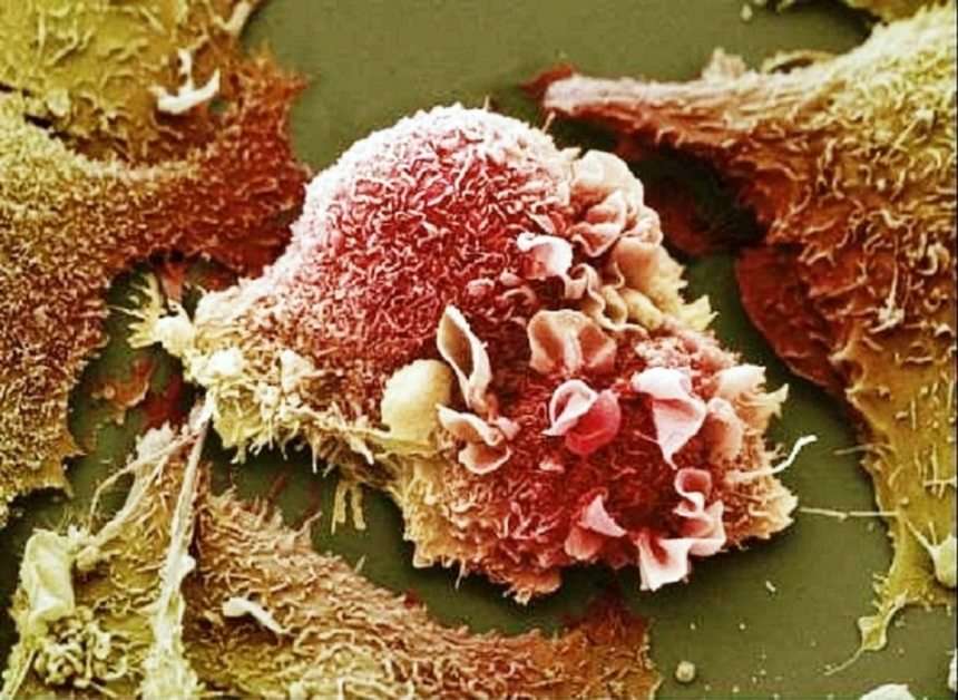 Célula cancerígena en el pulmón (microscopio) puzzle online