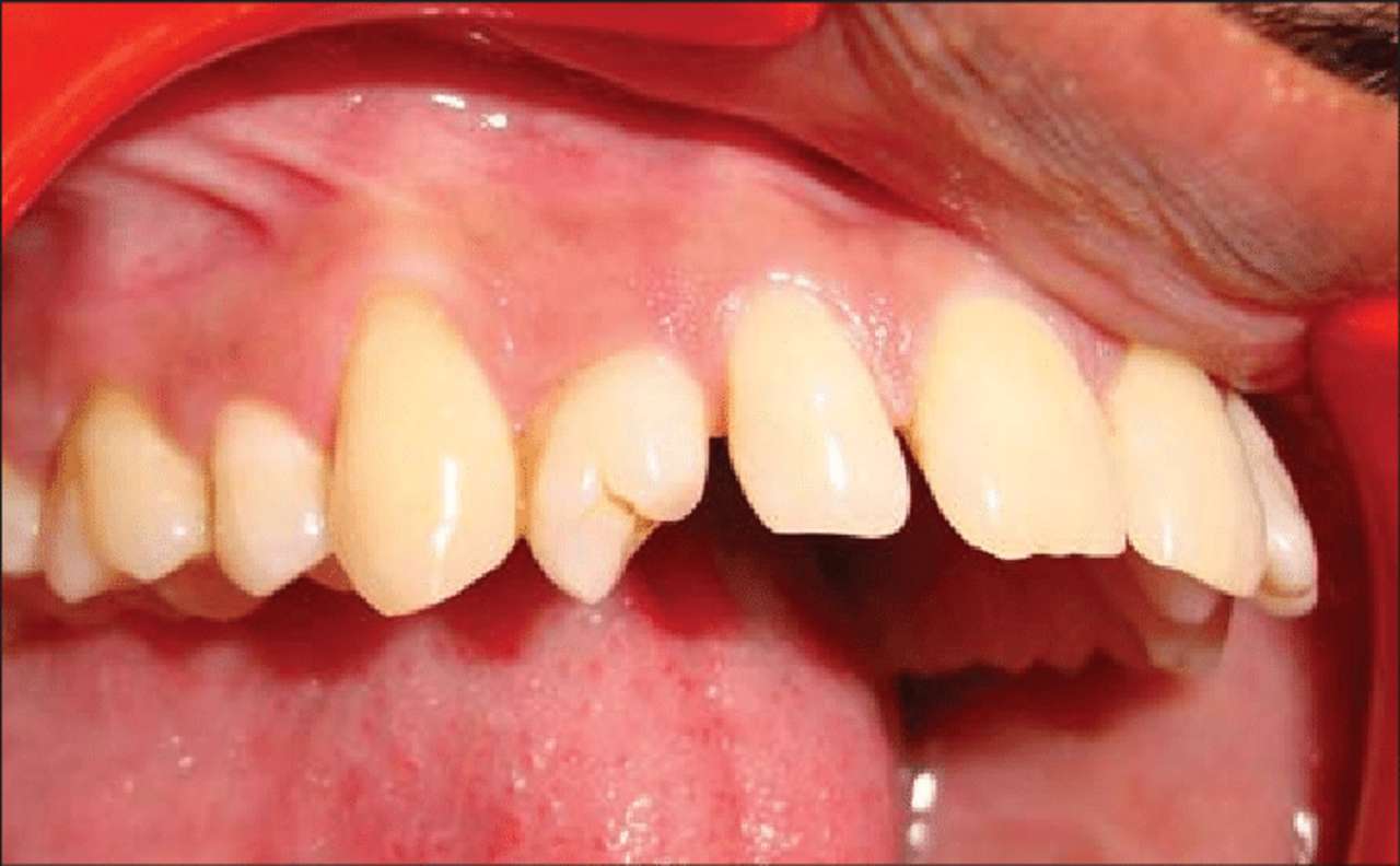 транспозиционни зъби онлайн пъзел от снимка