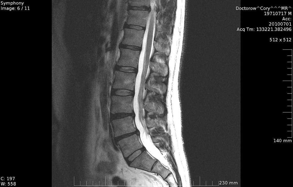 MRI LUMBAR SPINE puzzle online from photo