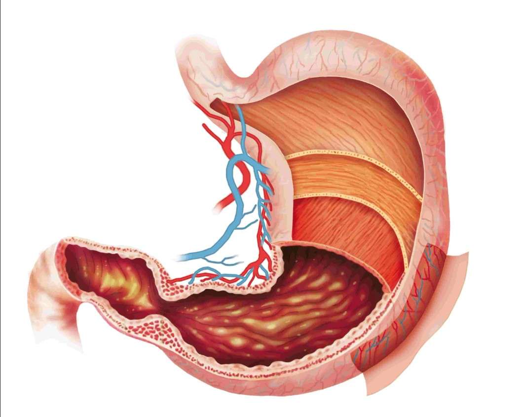 胃のアペルゴノン 写真からオンラインパズル