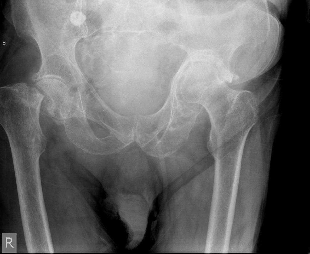 大腿骨頸部骨折 写真からオンラインパズル