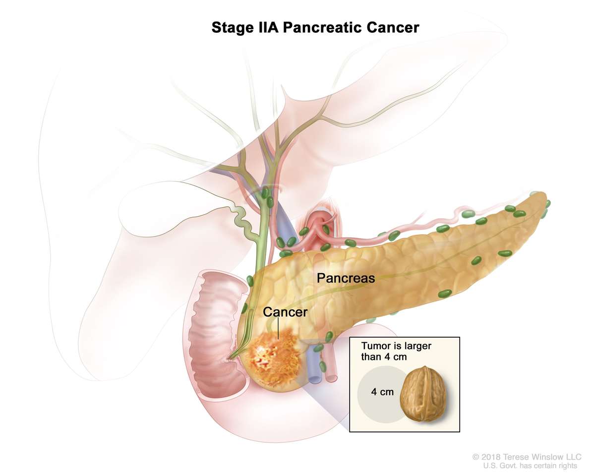 Tumore del pancreas puzzle online