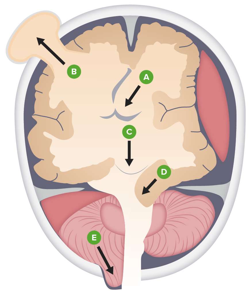 A herniáció típusai puzzle online fotóról