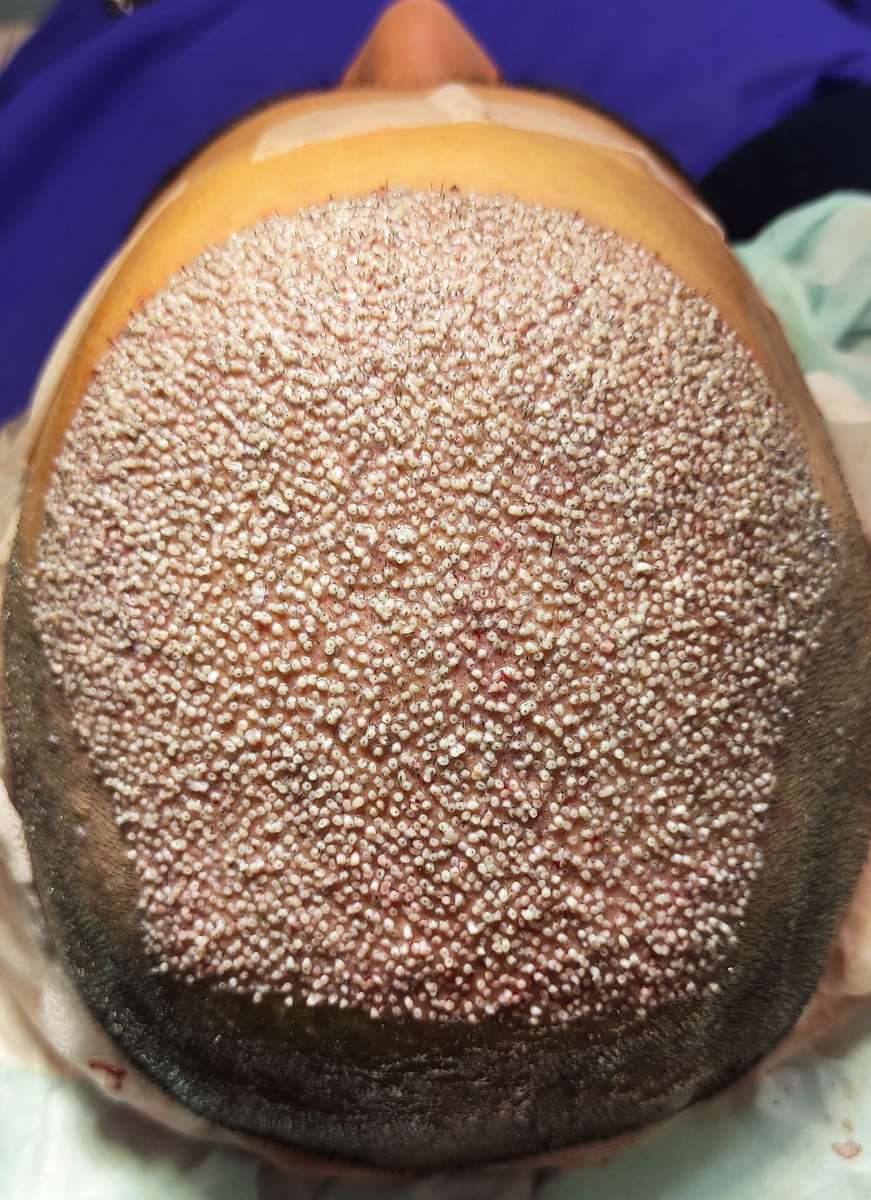 Hair transplant puzzle online from photo