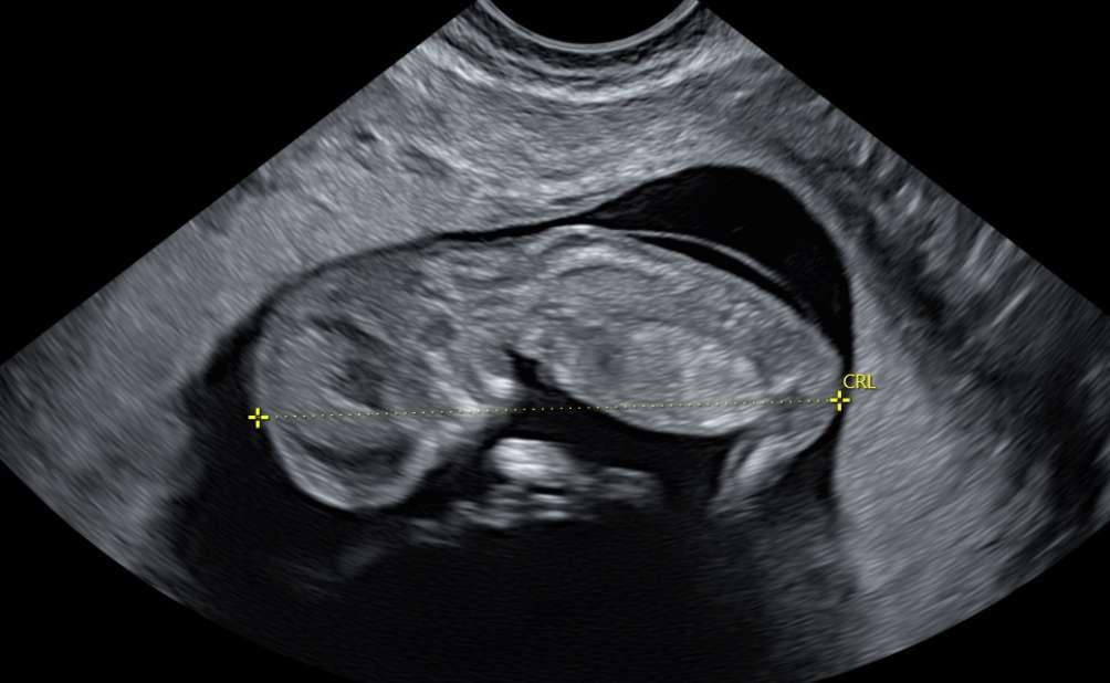Avslöjande av graviditeten pussel online från foto