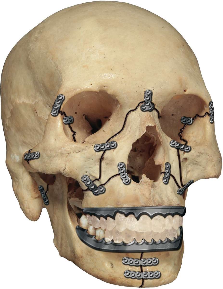 汎顔面骨折 写真からオンラインパズル